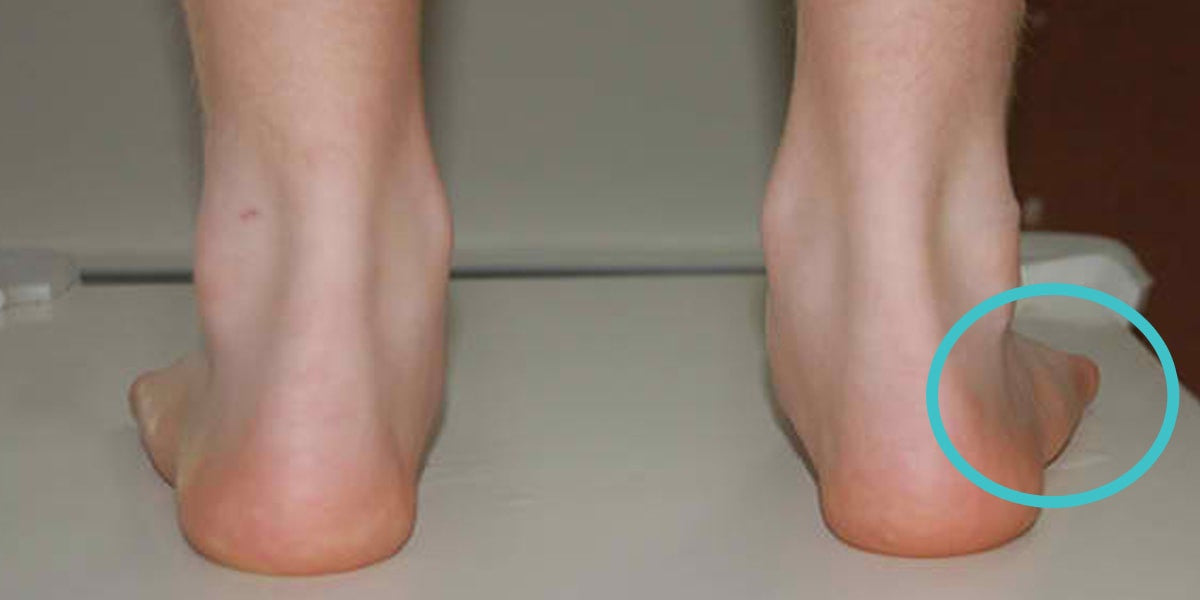 posterior tibial tendonitis insoles