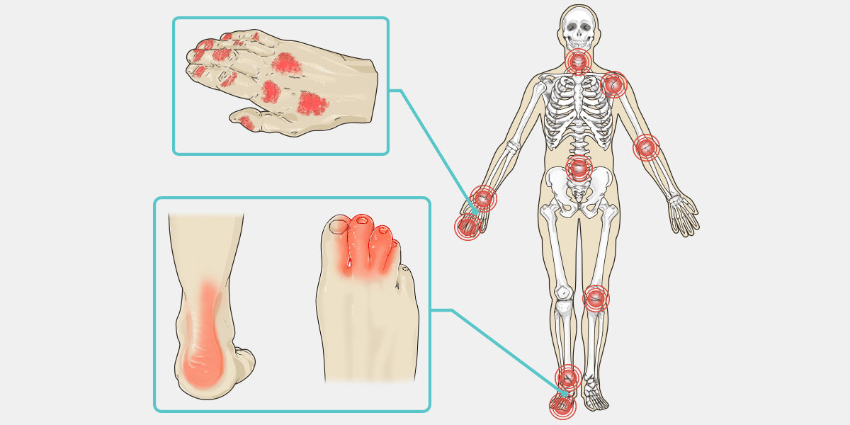 Psoriatic Arthritis Diagram