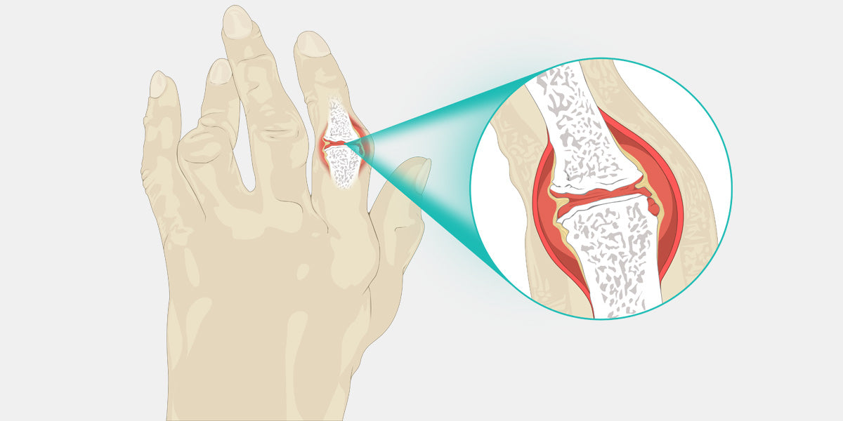 Rheumatoid Arthritis Illustration