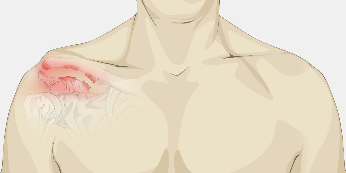 Shoulder Separation - The Complete Injury Guide - Vive Health