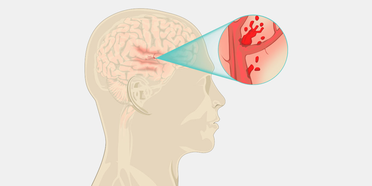 Vascular Dementia Illustration