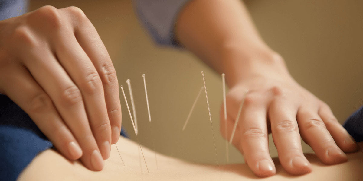 acupuncture to relieve muscle knots