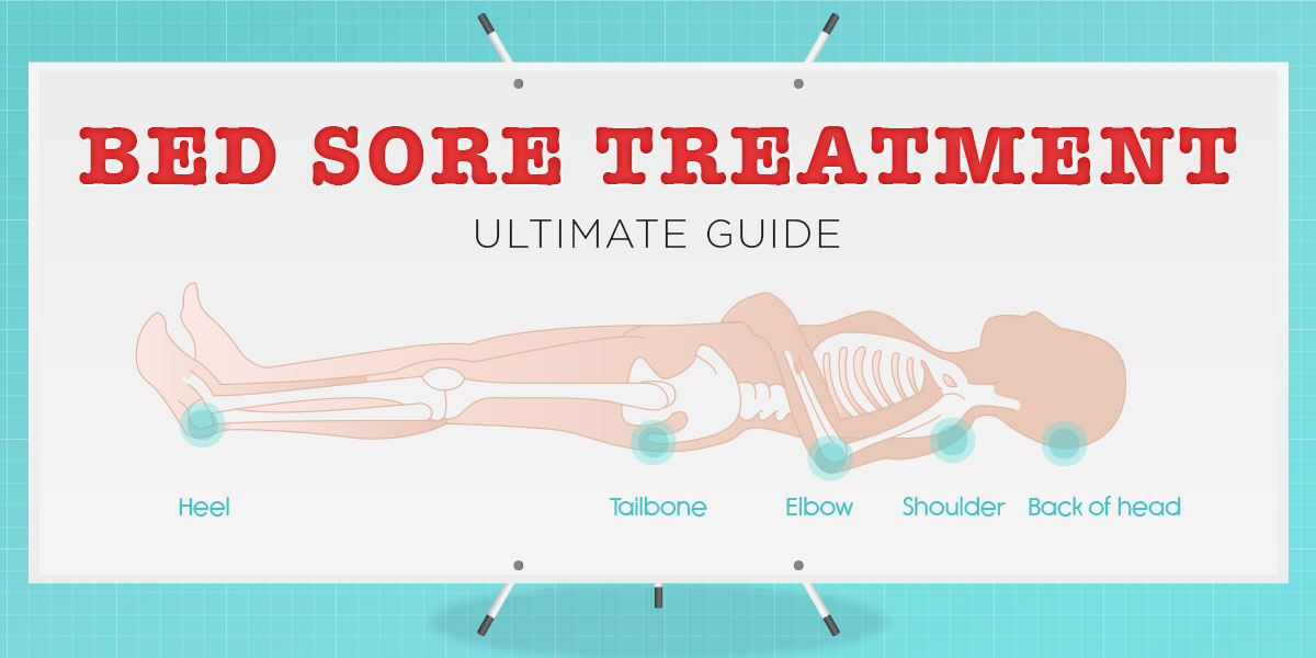 Bed Sores Treatment [Ultimate Guide] - Vive Health