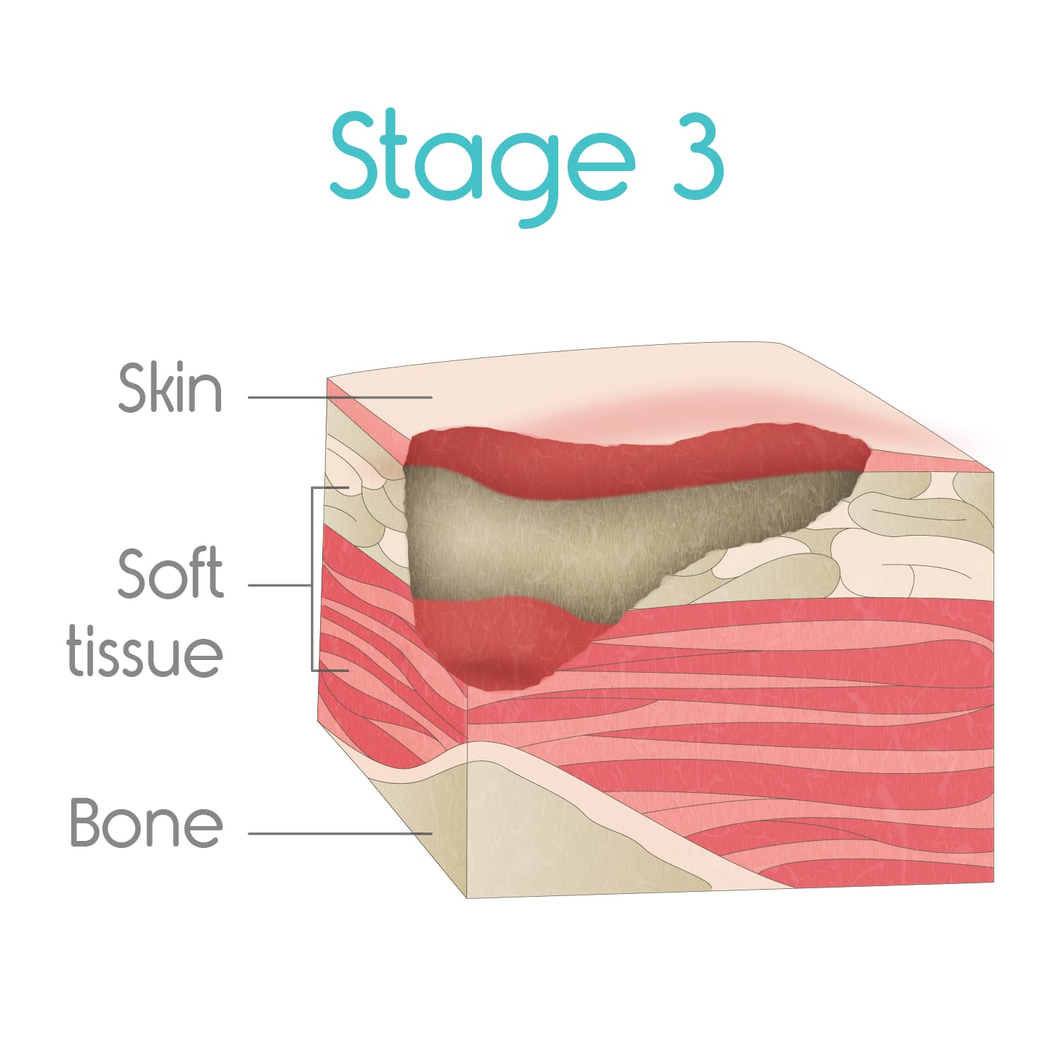 British Journal of Nursing - Preventing and managing device-related pressure  ulcers in oncology