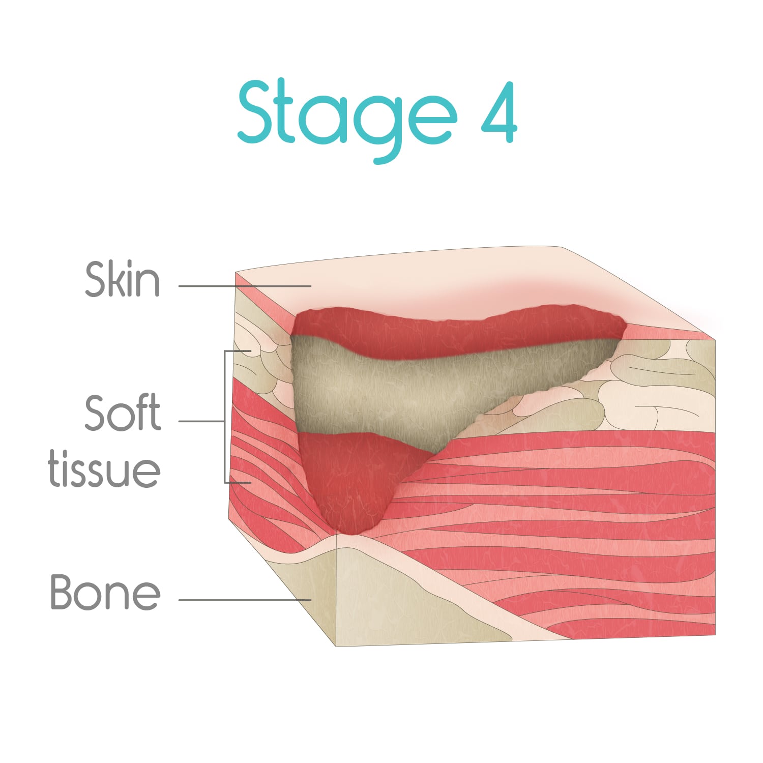 stage four bed sores