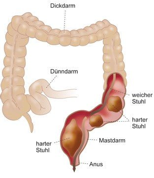 Harter Stuhl sammelt sich im Enddarm an und blockiert den Darmausgang. Es kommt zu Verstopfung oder Kotstau.