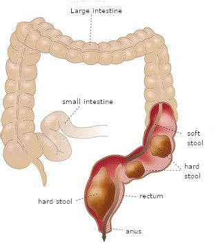 The large intestine / rectum gets blocked by hard stool