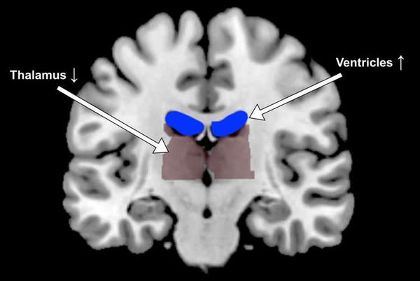 Gehirn MRT