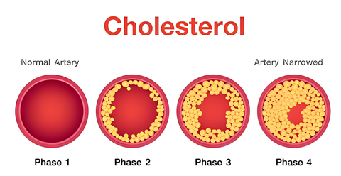 Heart Blocakage - Cholesterol