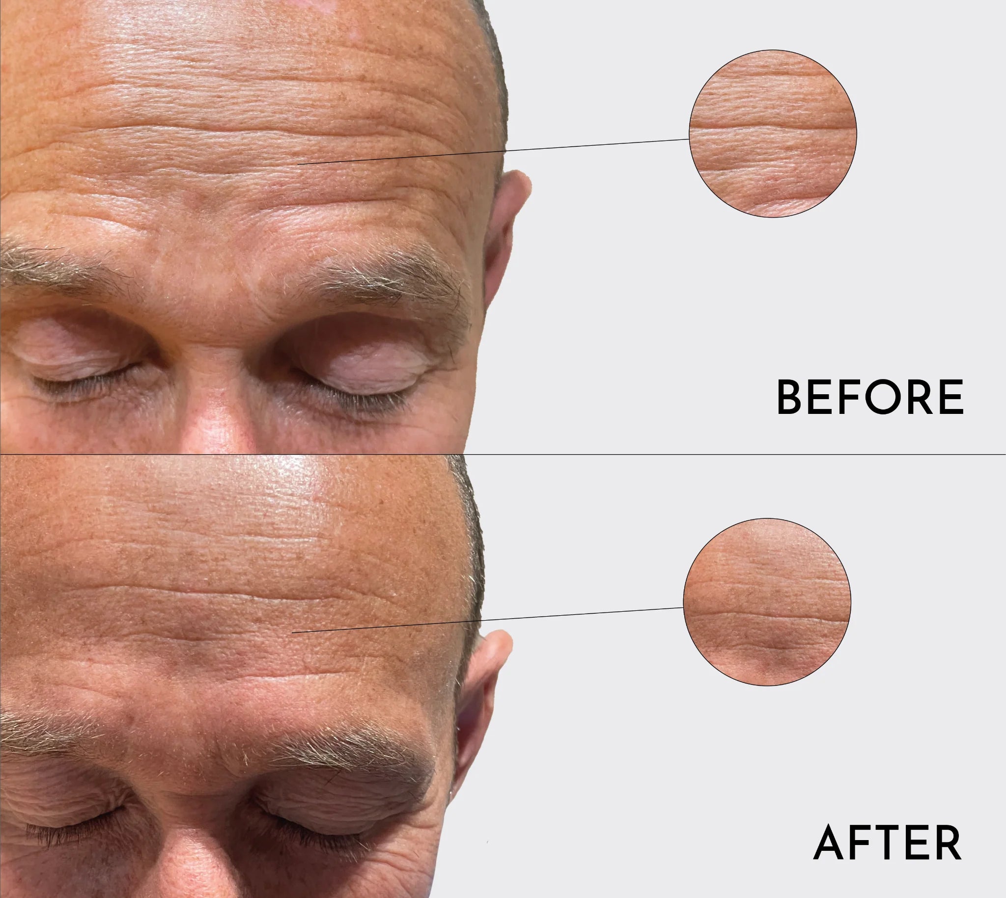 Comparison of forehead skin texture before and after treatment, showing reduced wrinkles.