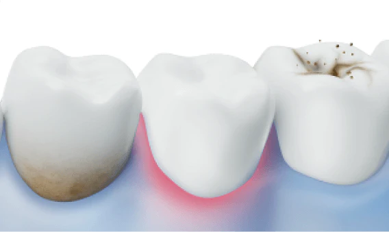 cause of periodontitis