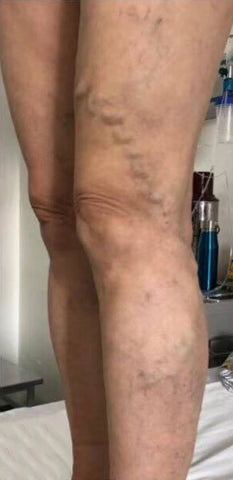 Cuysx™ Varicose Veins Spray