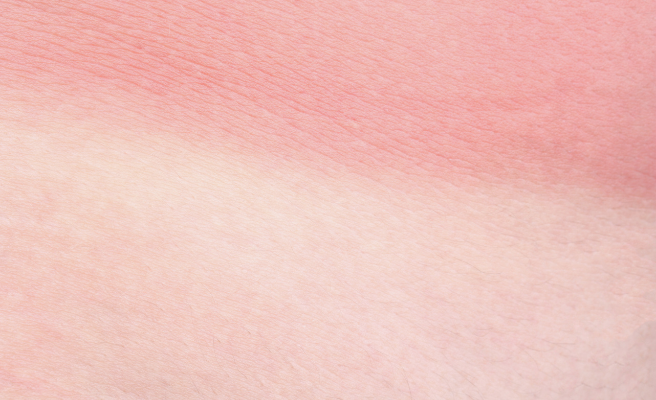 sunburn