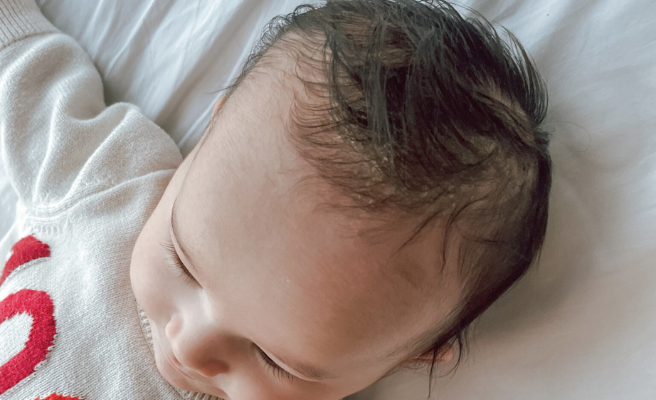 baby's cradle cap