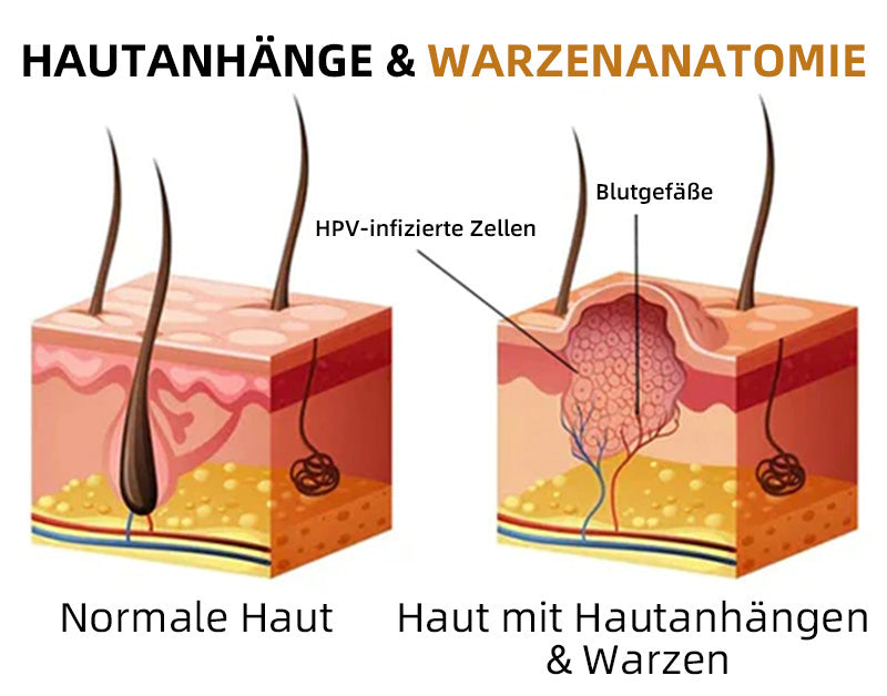 Ourlyard™ Biene Venom Wart und Tags Entfernung Behandlung Spray