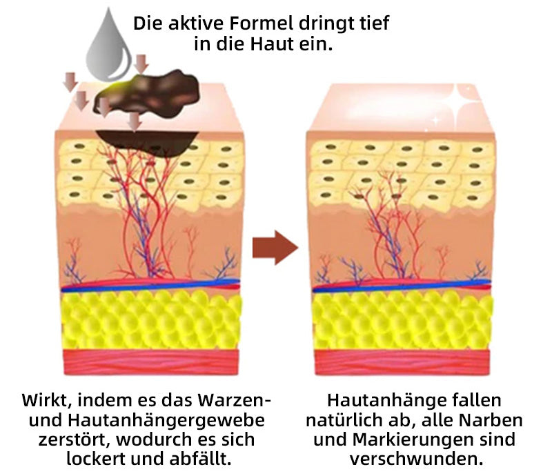 Ourlyard™ Biene Venom Wart und Tags Entfernung Behandlung Spray