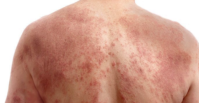 Atopic-Dermatitis.jpg__PID:ed4df785-b129-4bbb-b279-56afbc24ce96