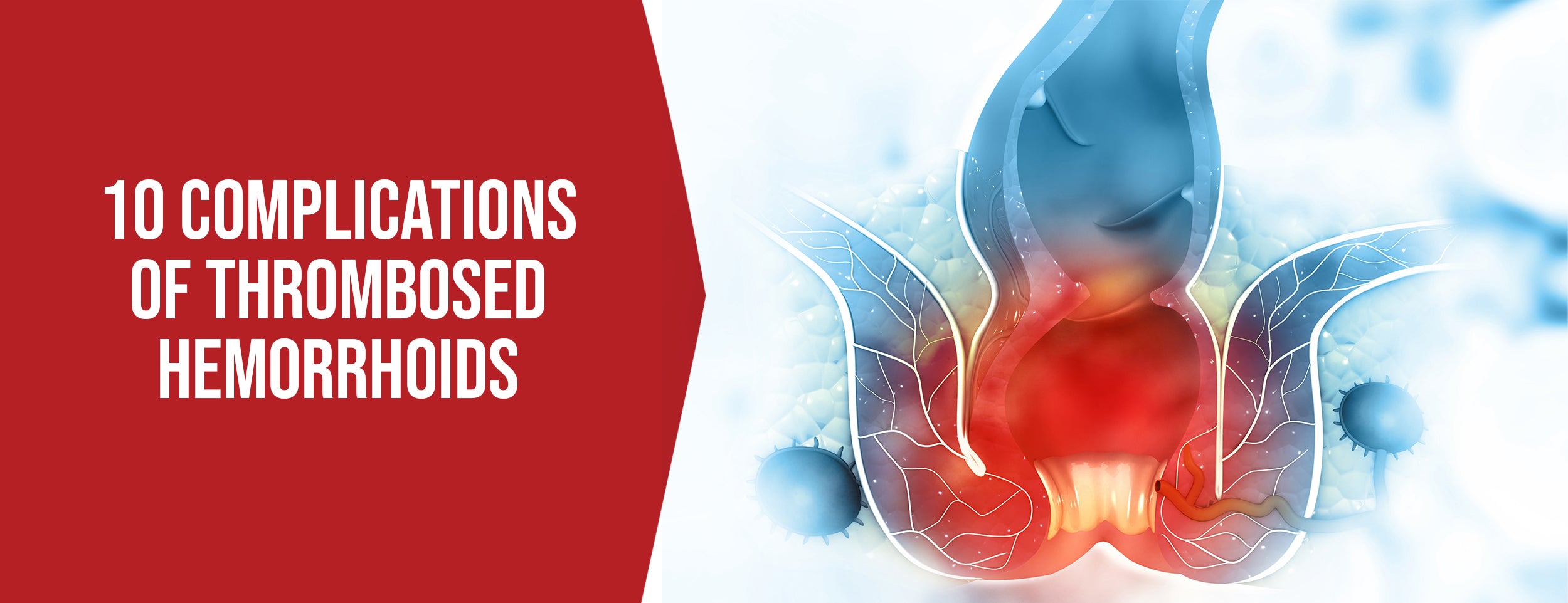 Here are 10 complications associated with thrombosed hemorrhoids