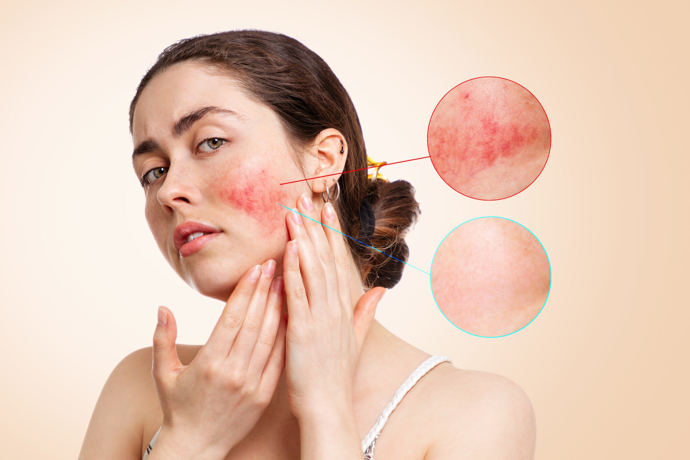 12 Methods for Treating Rosacea with Tea Tree Oil