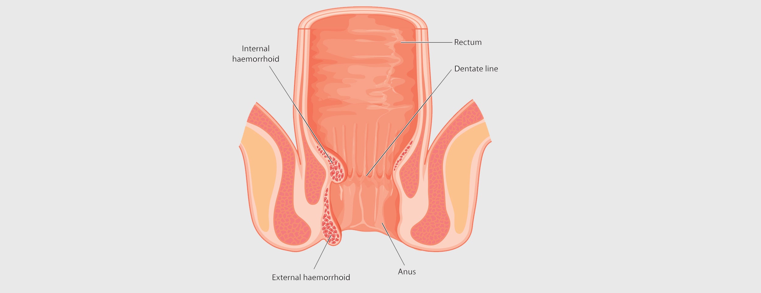 Here are 6 benefits of thrombosed hemorrhoids excision