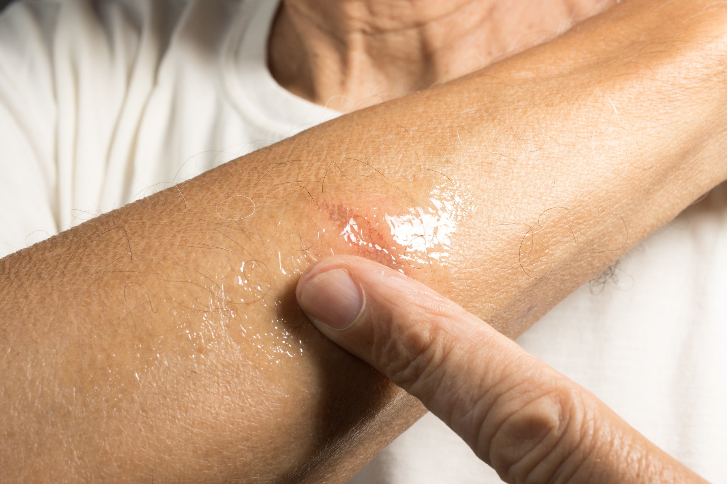 The 8 fastest ways to heal minor burns