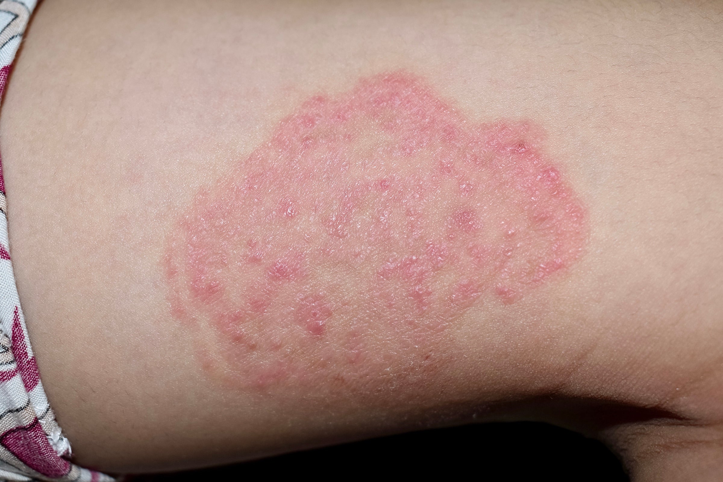 9 Tips for preventing fungal skin infections