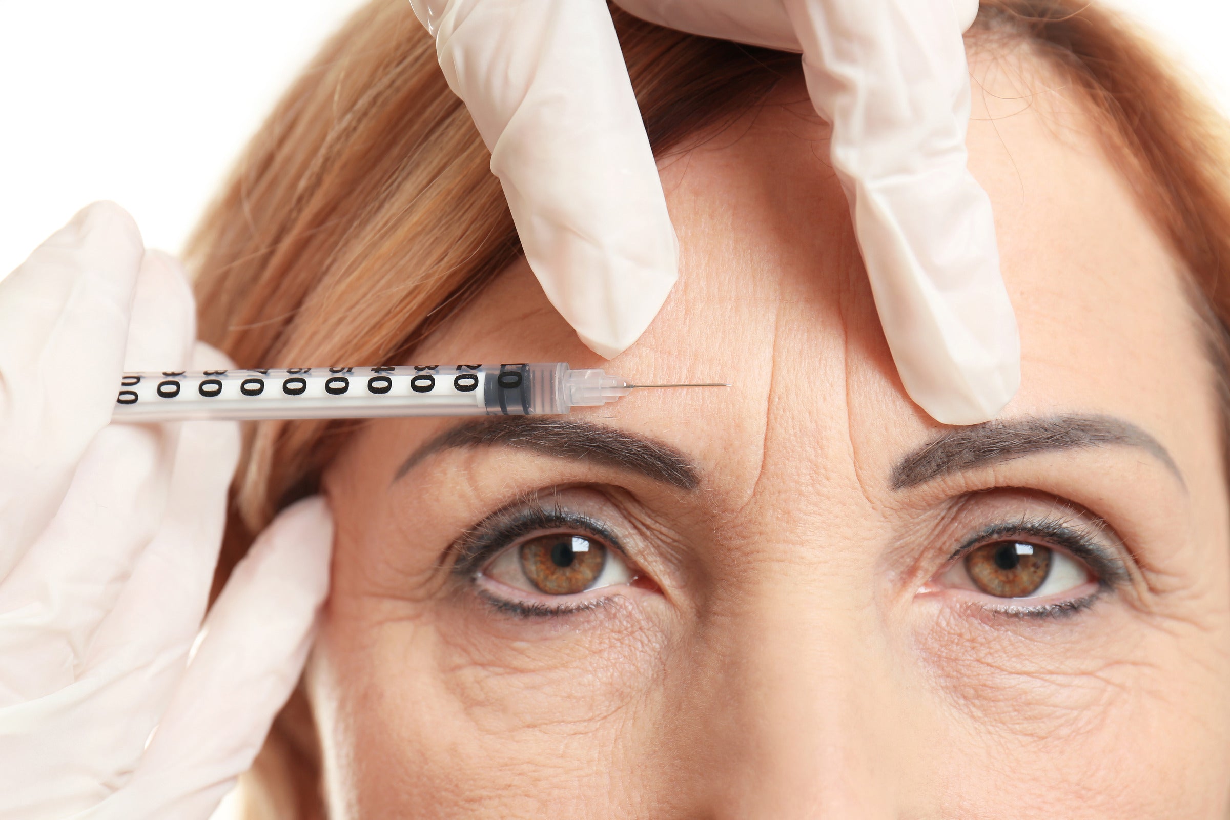 Botox lasts as long as the patient's forehead ages
