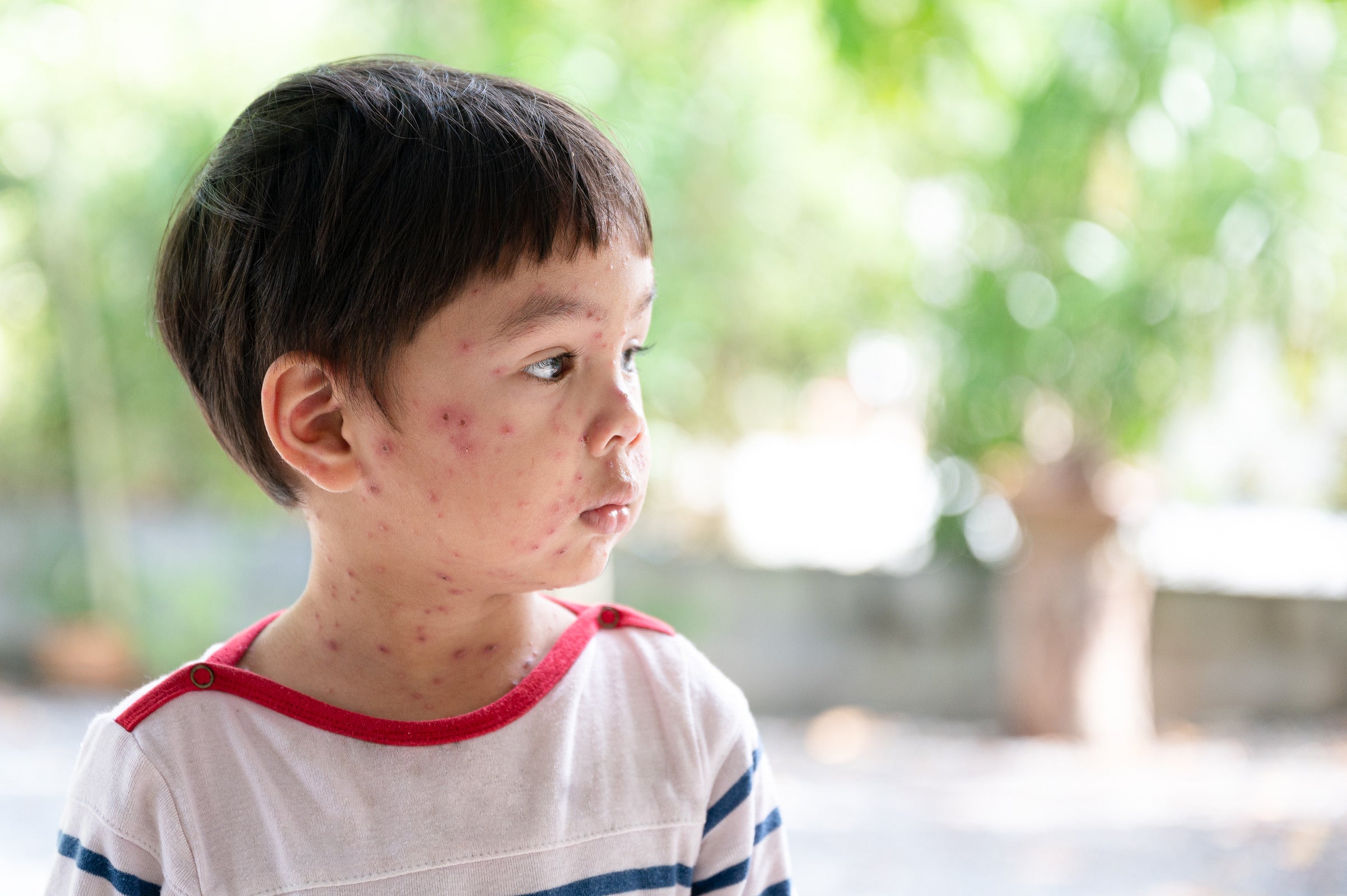 Risks and Benefits of Natural Immunity to Chickenpox