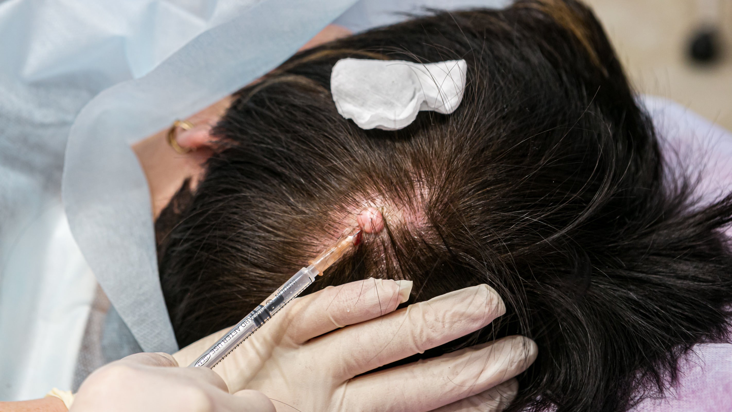 The 3 best methods for removing cysts with minor surgery