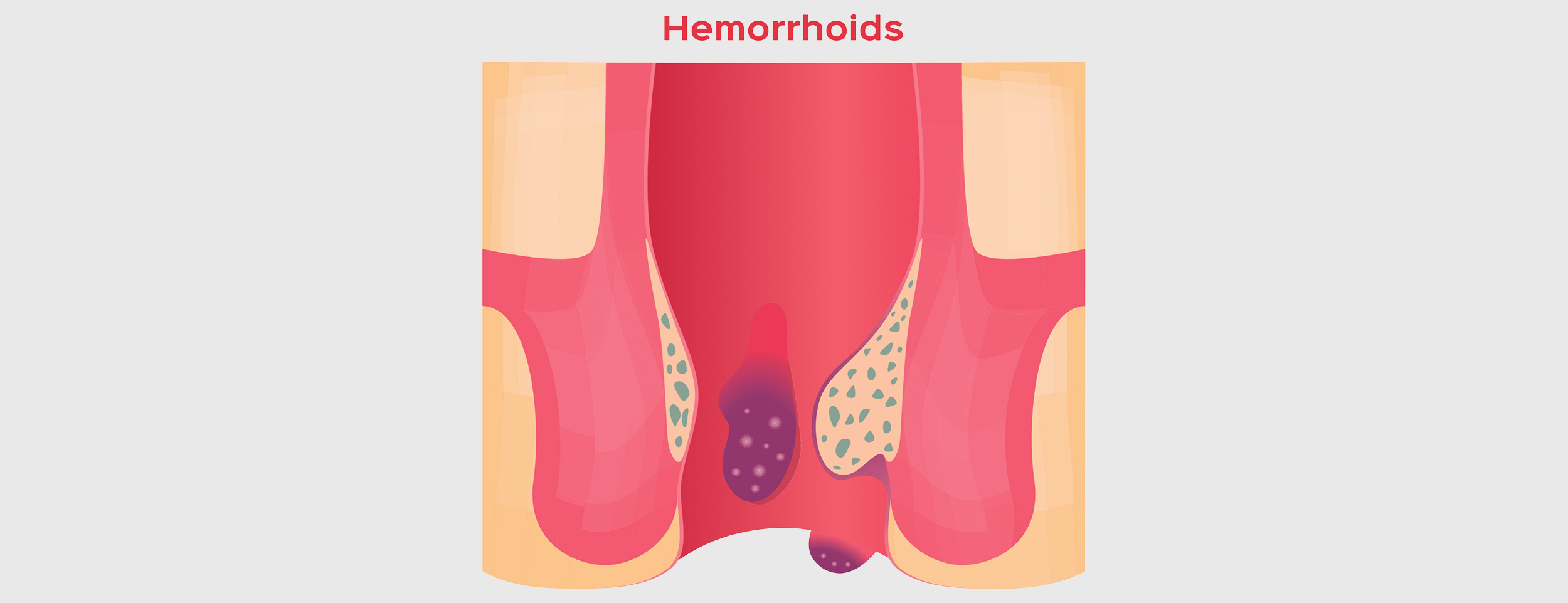 The anal area is blocked with hemorrhoids