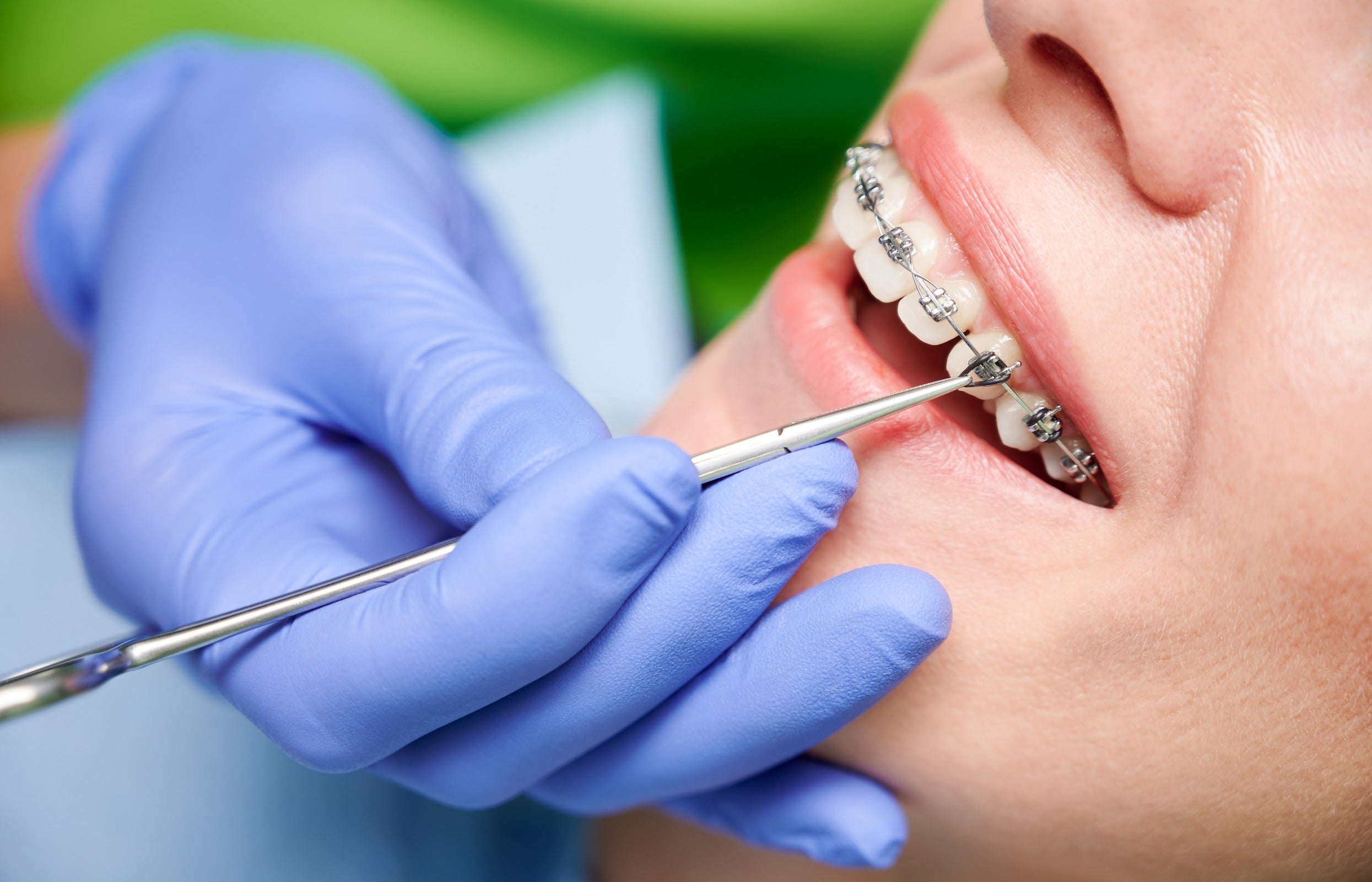 Factors to Consider When Wearing Braces With Tongue Piercing