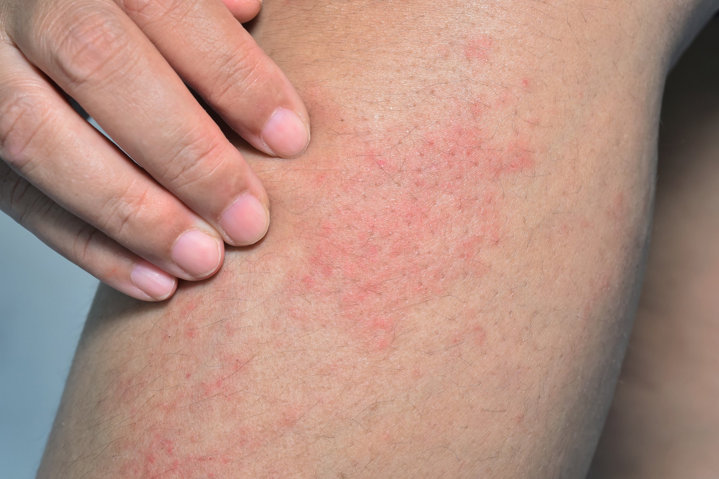 6 common symptoms of food allergy-induced itchy skin