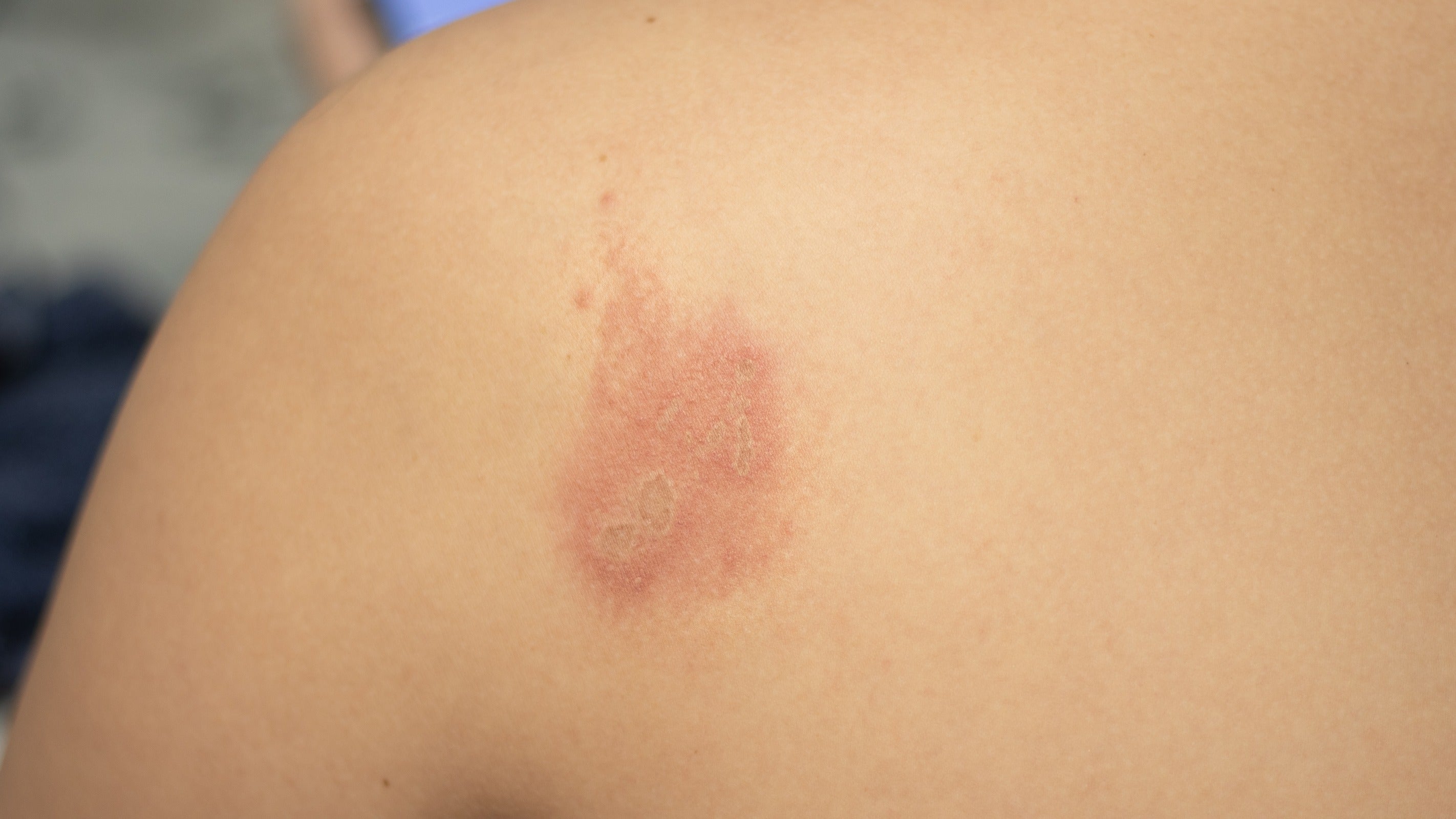 7 Reasons Insect Bites Cause Bruising