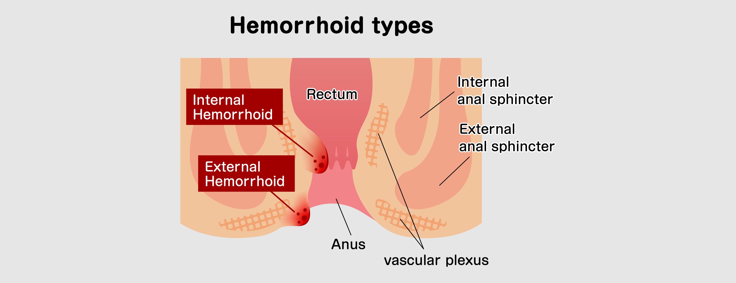 The best way to tell if you have an internal or external hemorrhoid