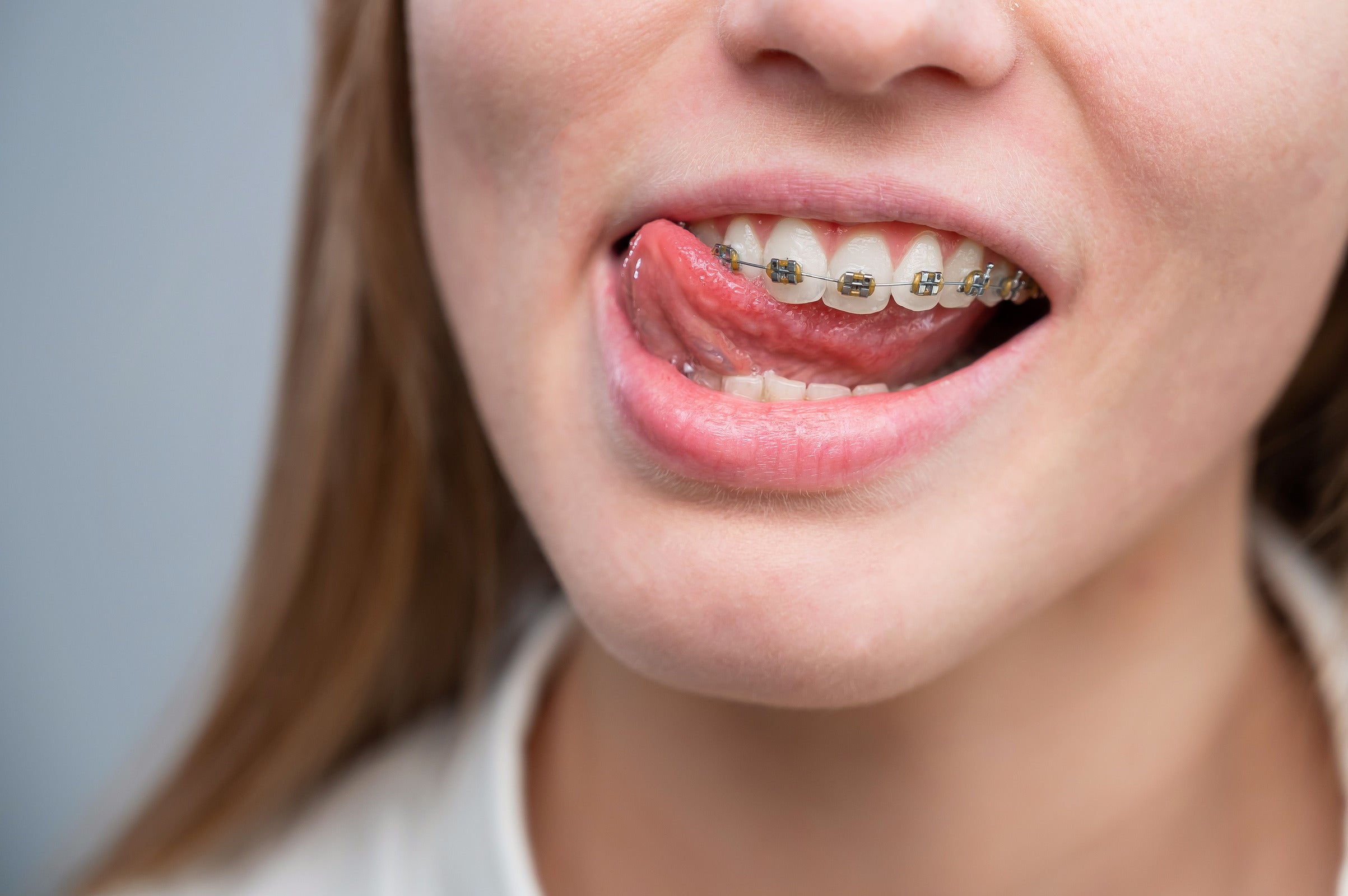 The Compatibility & Risks of Getting Braces with Tongue Piercing