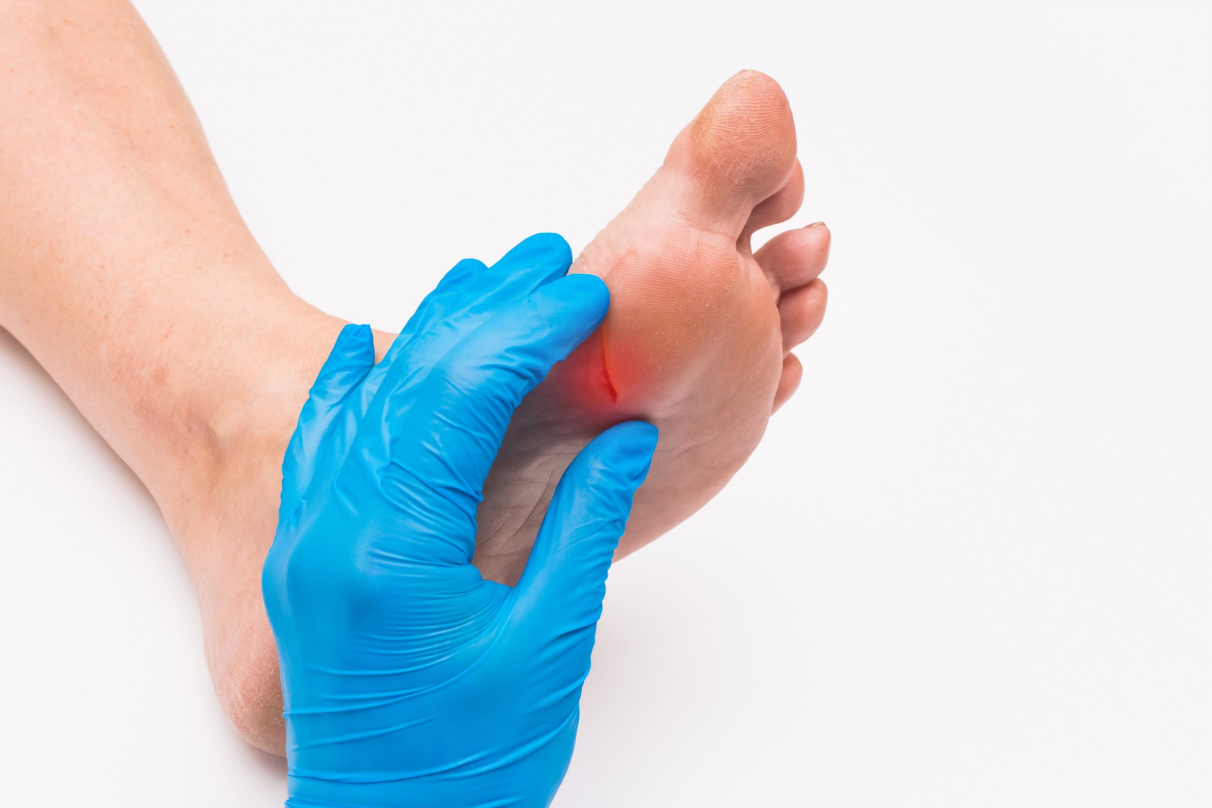 Puncture wound healing complications