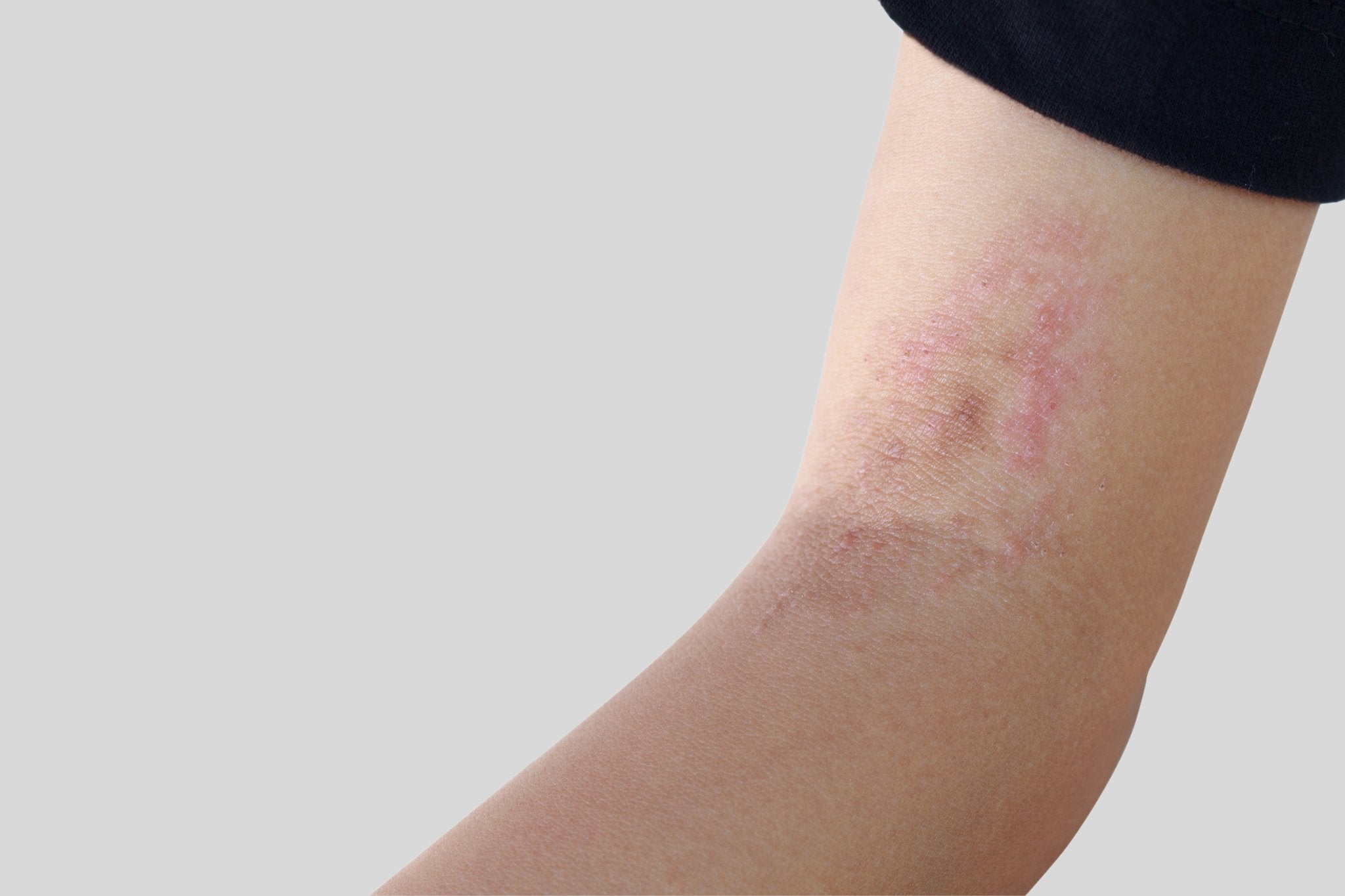 Fungal Skin Infection Treatment: 3 Best Methods