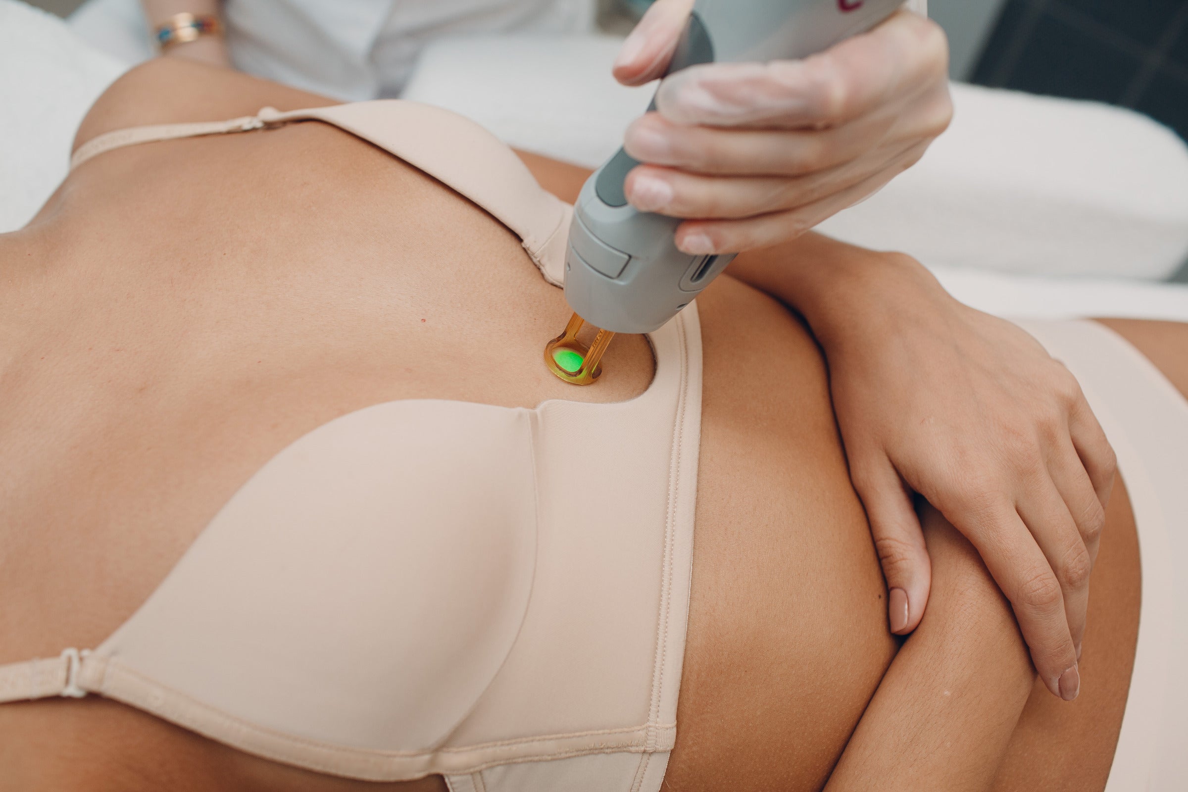 The potential impact of laser hair removal on breast cancer