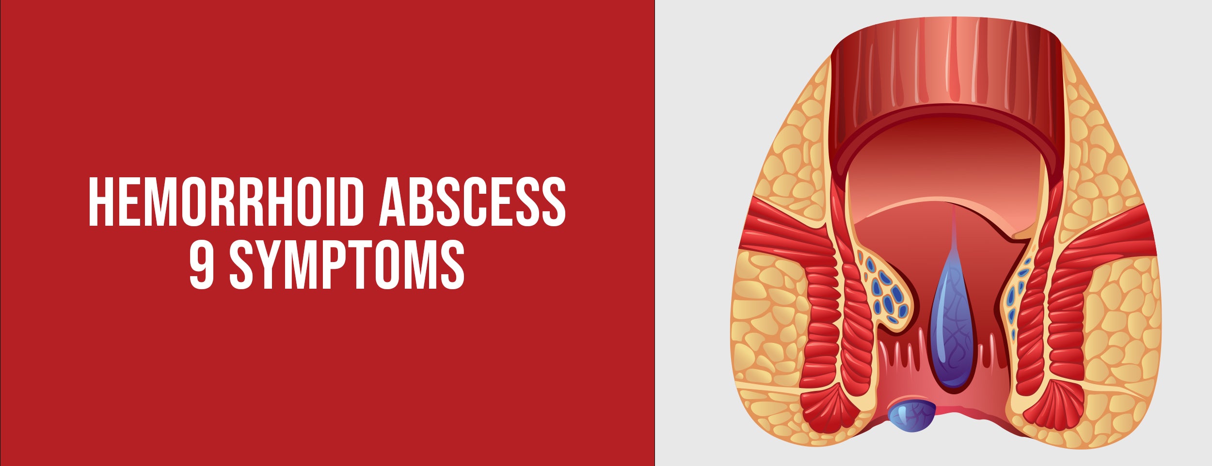 Nine symptoms of hemorrhoid abscess