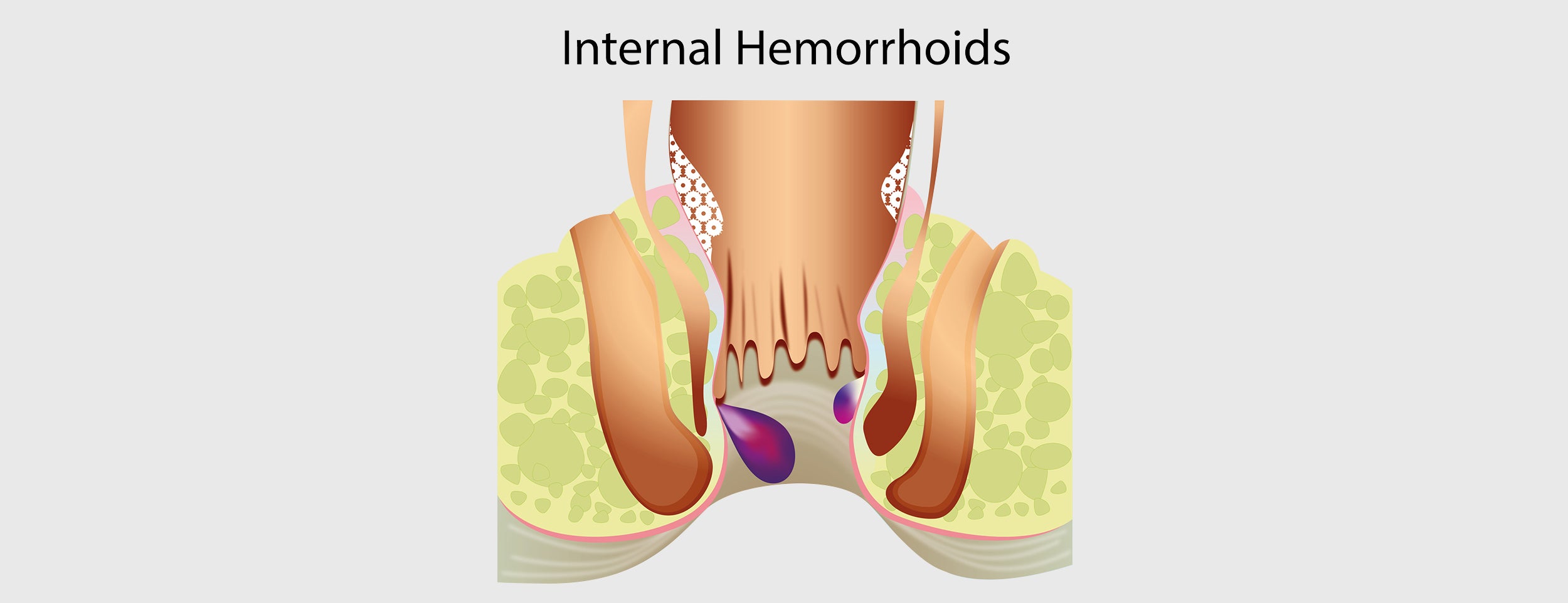 Mucus associated with hemorrhoids