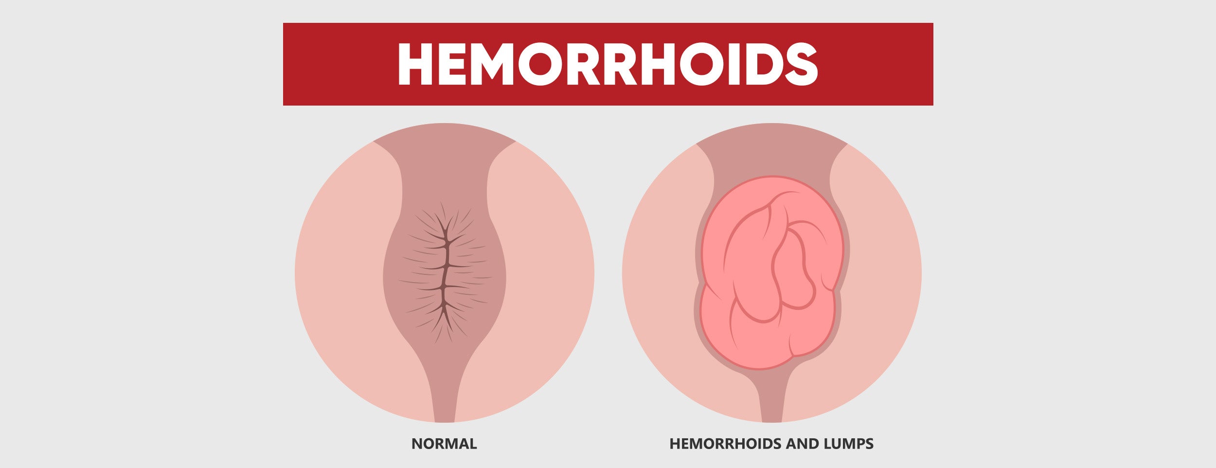An External hemorrhoid infected with a hole