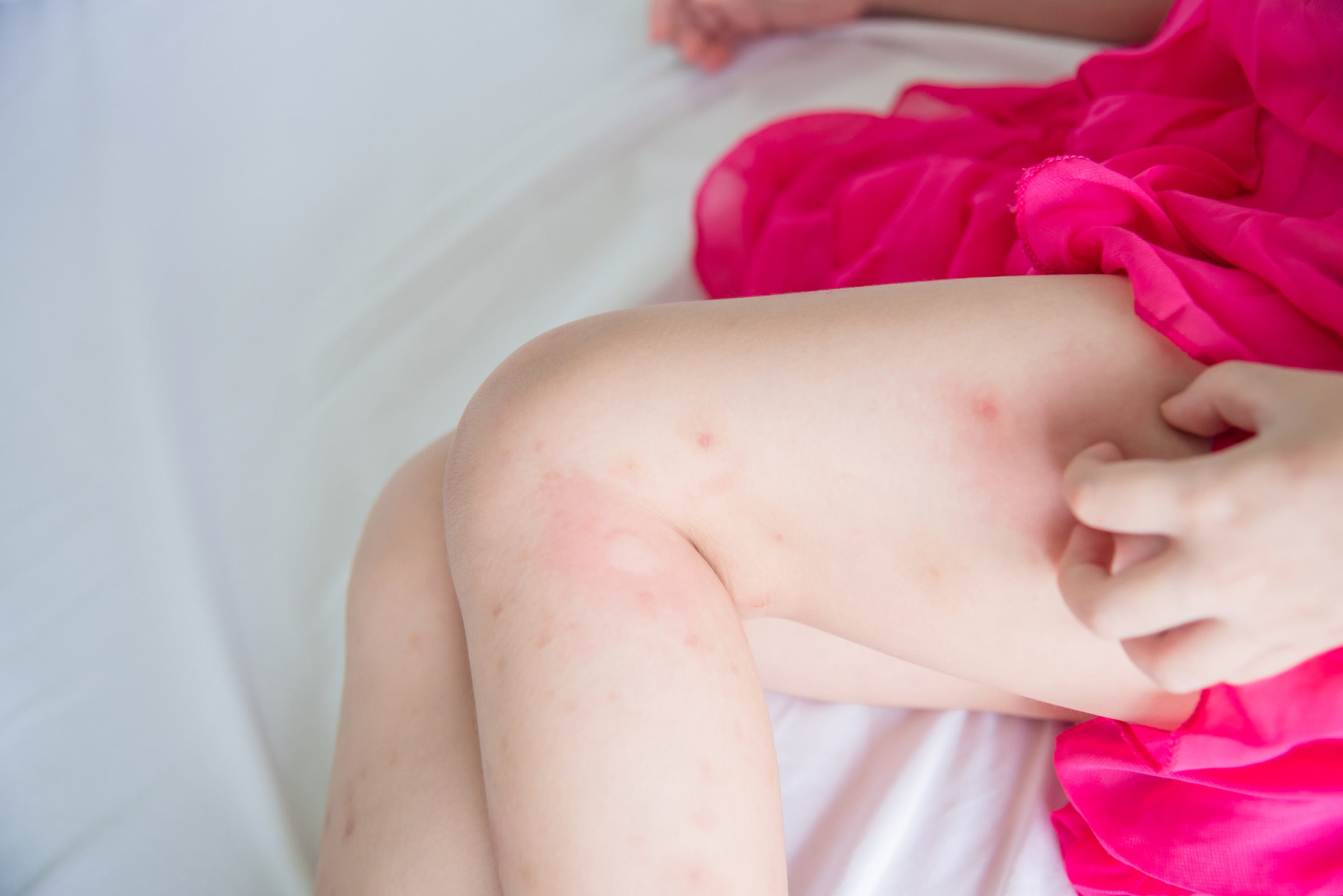 10 Natural Treatments for Bed Bug Bites that Itch and Swell
