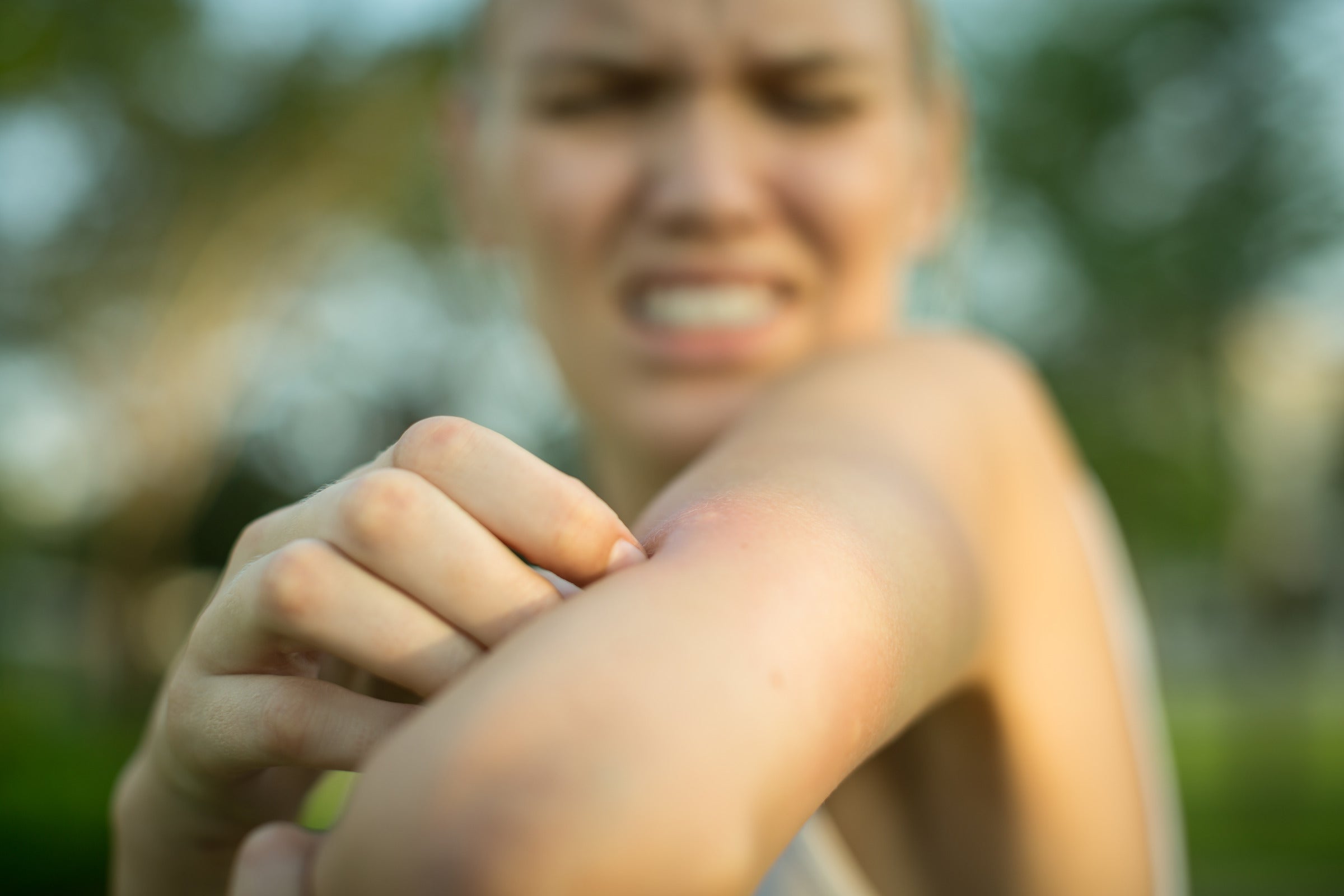 The 15 most effective home remedies for bug bites that itch and swell