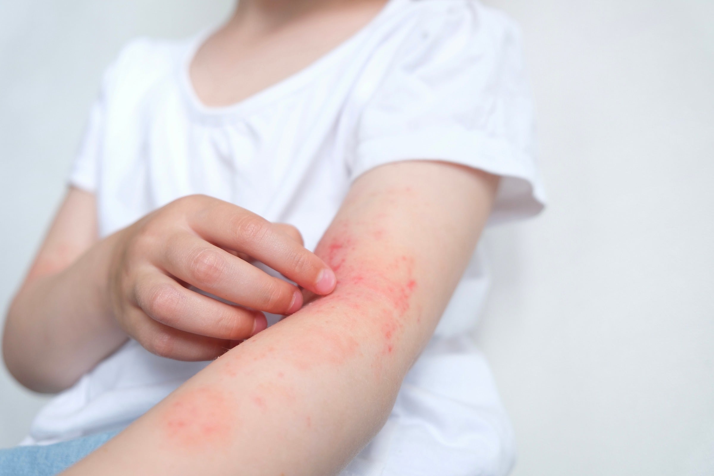 Home Remedies for Skin Allergies