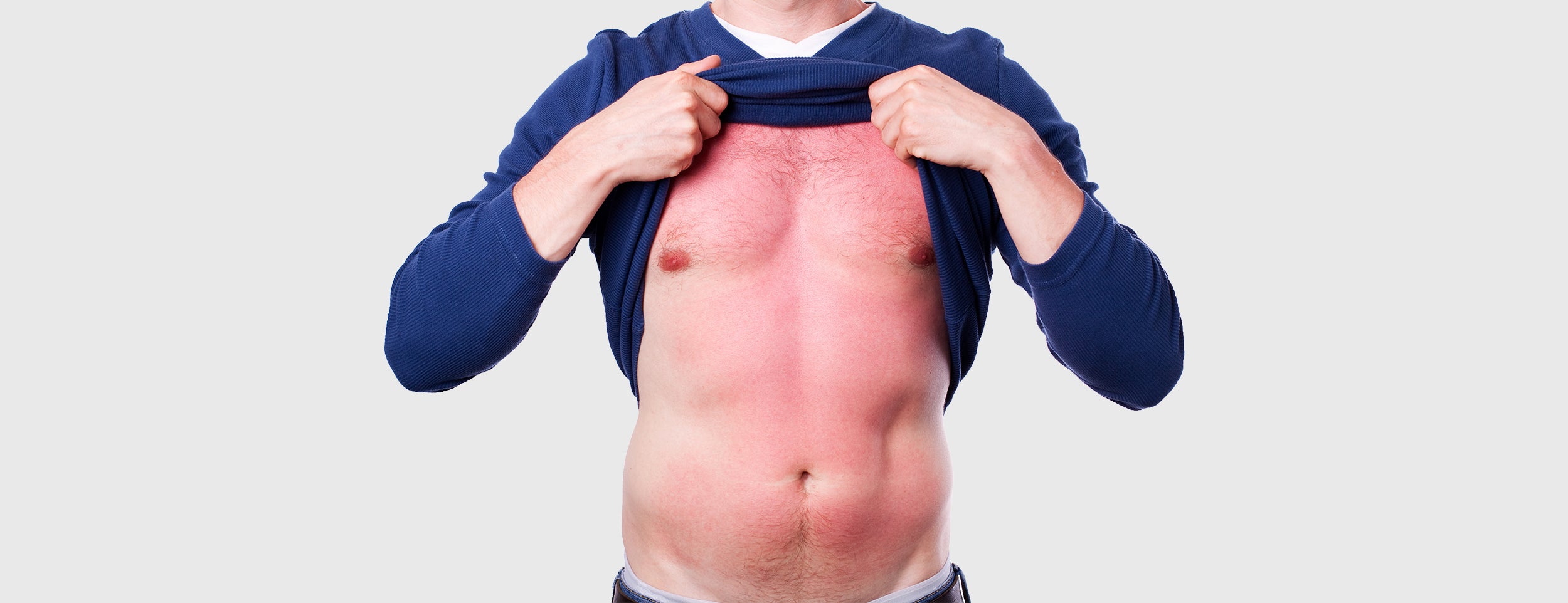 Six factors to consider when sleeping with a sunburn