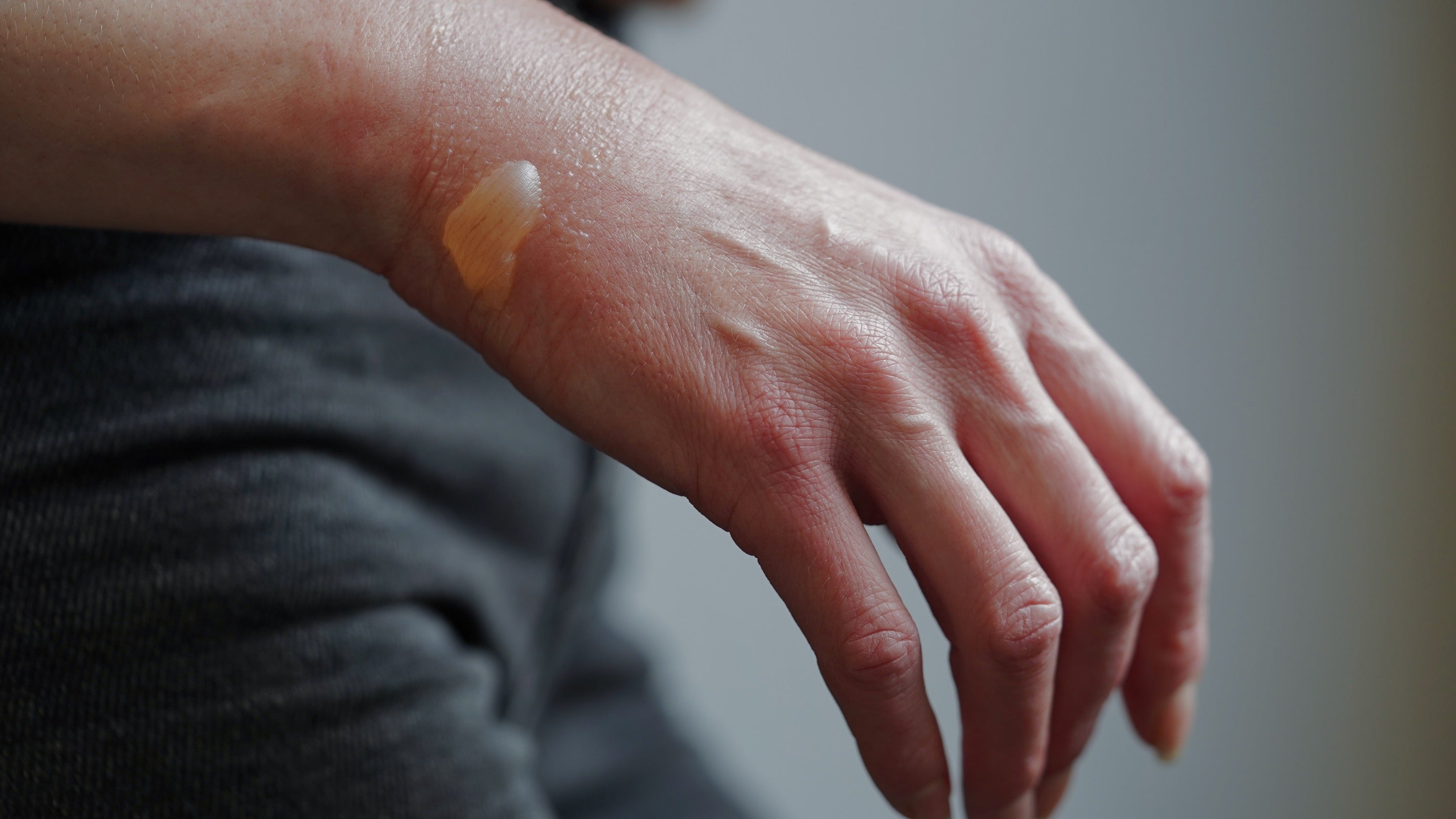The 3 Factors Affecting the Time it Takes to Heal a Minor Burn