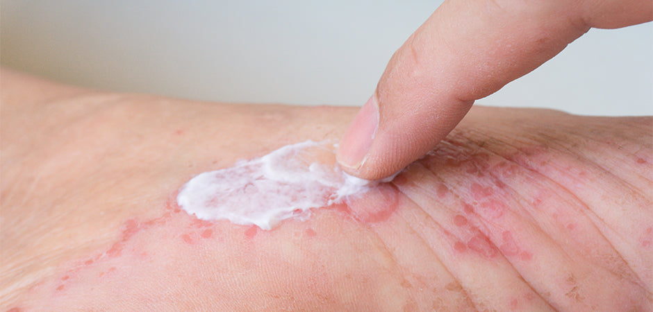 2 Medical Tips for Treating a COVID-19 Rash