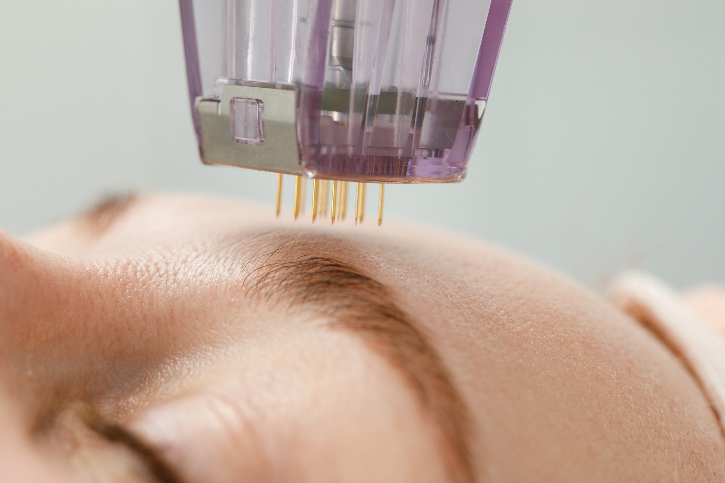 9 Effective Microneedling Processes to Speed Up Healing