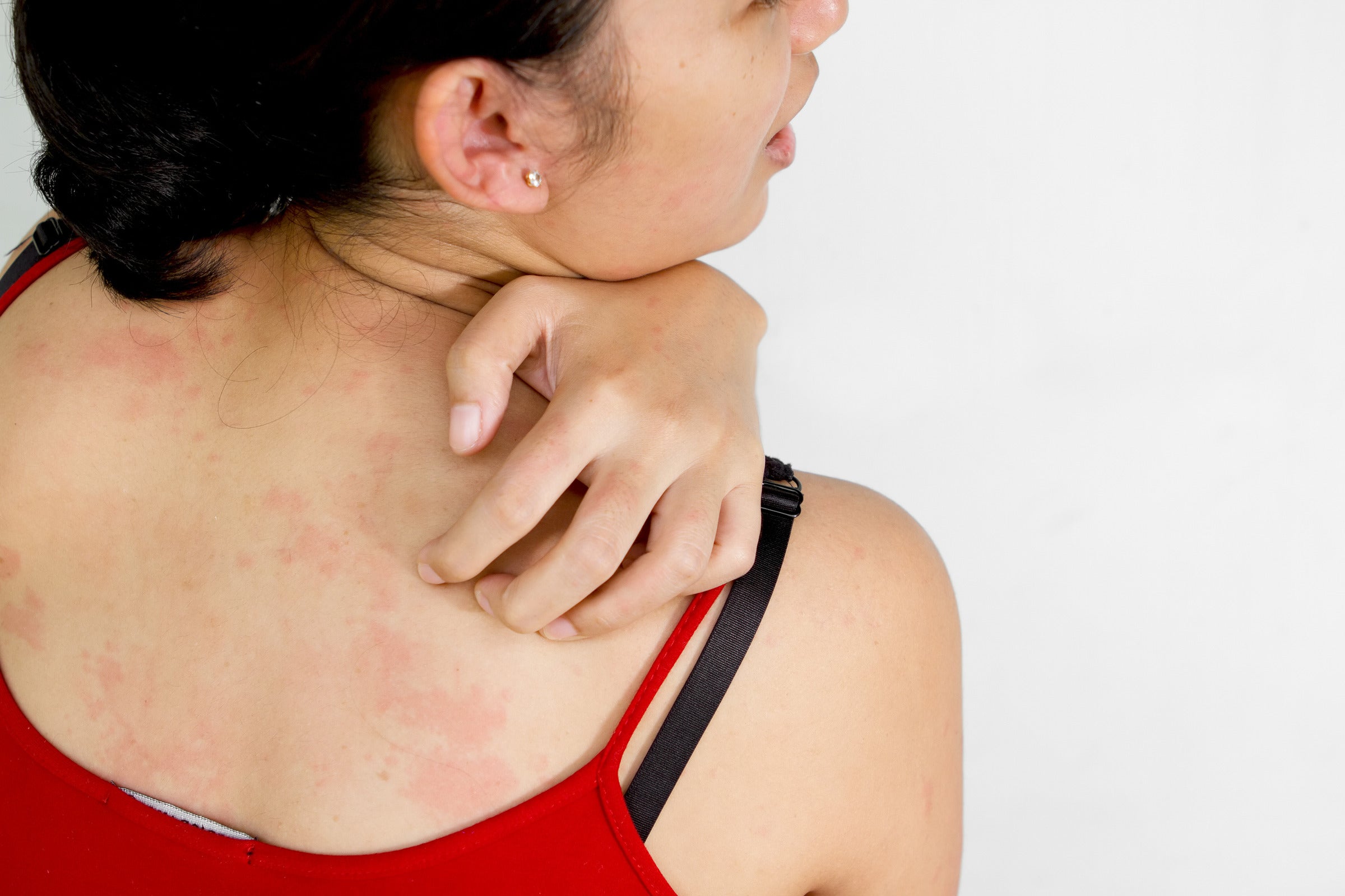 Treatment for Burning Skin Sensation