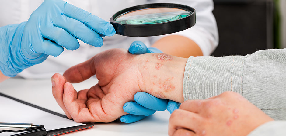 Treatment of Contact Dermatitis: When To Seek Medical Attention